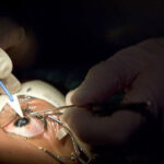 LASIK Your Path to Clear, Glasses Free Vision